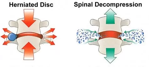 Spinal Decompression